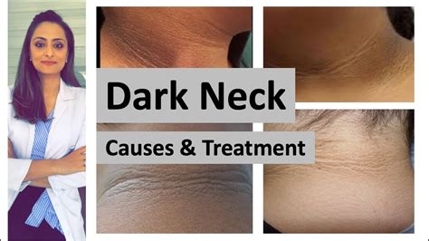 Dark Neck Causes Treatment Home Remedies Dermatologist Dr