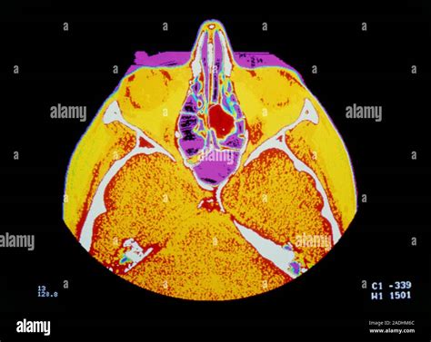 False Colour Computed Tomography Ct Scan Of An Axial Section Through