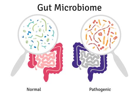 Demystifying Dysbiosis Canadian Digestive Health Foundation