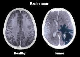 But sometimes your cat may have a tumor that you can't feel from the outside. What does a Brain Tumor Feel Like? | New Health Advisor