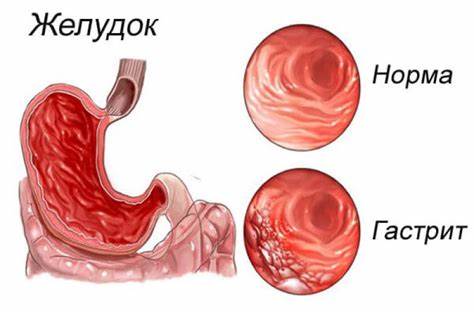 Диета геморрагический гастрит Гастрит - признаки, причины, симптомы, лечение и профилактика - iDoctor.kz Гастрит - признаки, причины, симптомы, лечение и профилактика - iDoctor.kz Диета геморрагический гастрит