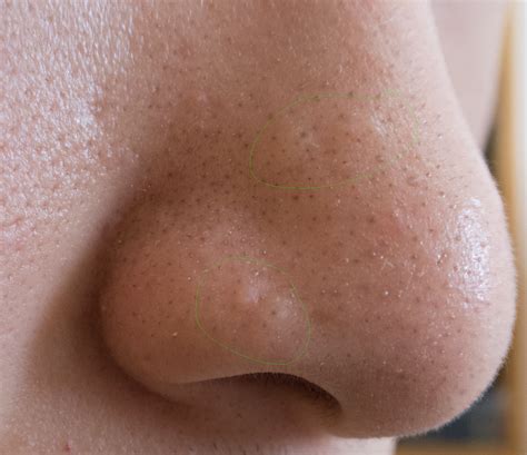 With Pictures Flesh Colored Bumps On Nose Hypertrophic Raised Scars Forum