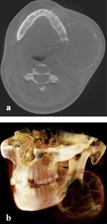 Enormous Aneurysmal Bone Cyst Of The Mandible Case Report And