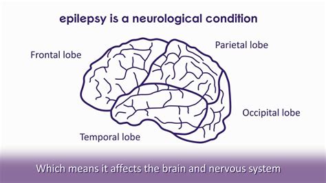 Flickering or high frequency light sources are often triggering for those with photosensitive epilepsy. What is epilepsy? | Epilepsy Society - YouTube