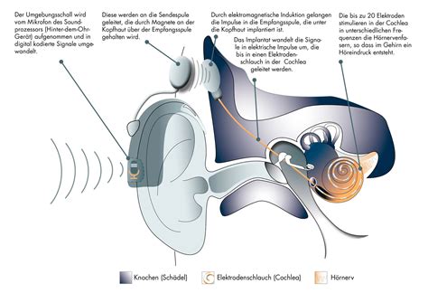 Cochlea Implantat Wie Ein Innenohrimplantat Bei Taubheit Helfen Kann