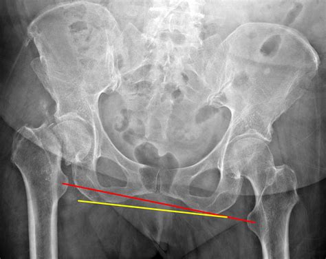 Femoral Neck Fracture Nomenclature Uw Emergency Radio