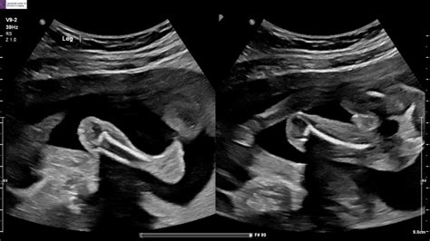 Any Ultrasound Experts Here Echogenic Bowel Babycenter