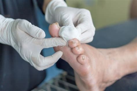 Tips To Prevent Diabetic Foot Ulcers At The Early Stages