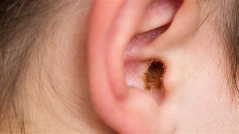 How To Safely Remove Ear Wax