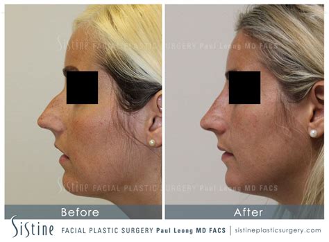 Nose Before And After 09 Sistine Facial Plastic Surgery