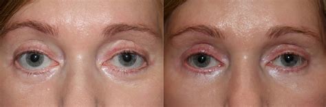 Lower Eyelid Retraction Repair Dr Guy Massry