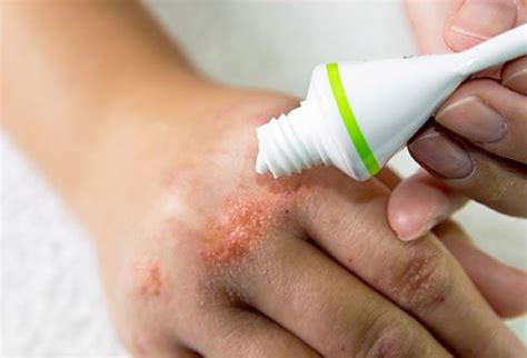 what is contact dermatitis effects and how to treat it