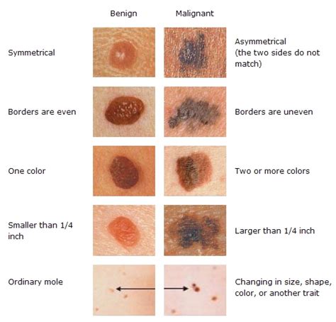 Skin Lesions Aesthetic Institute Dublin