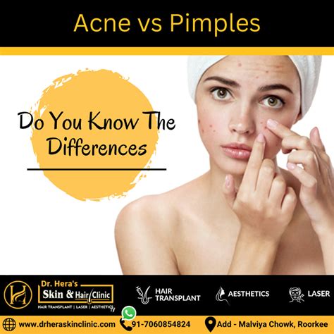 Acne Vs Pimples Do You Know The Differences Dermatologist In Roorkee