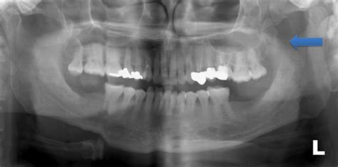 Fractured Zygomatic Arch A Traumatic Cause For Trismus Bmj Case Reports