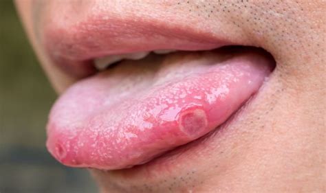 Hiv Symptoms Early Signs May Include Mouth Ulcers Or Sores Uk