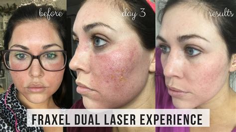 Fraxel Dual Laser Treatment For Acne Scars Day By Day Results