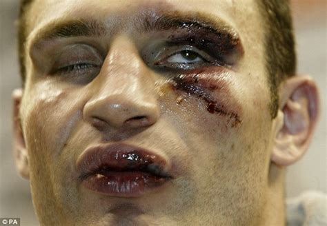 Worst Sports Black Eyes After England Captain Chris Robshaw Gets Shiner