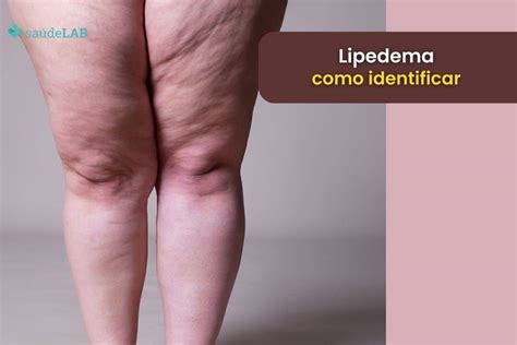 Lipedema como identificar e qual é a melhor maneira de combater ele