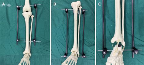 Early Complications Of Preoperative External Traction Fixation In The