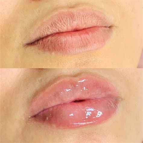 Hydra Gloss Lips Contraindicações