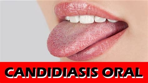 Como Detectar Y Como Tratar La CANDIDIASIS BUCAL YouTube