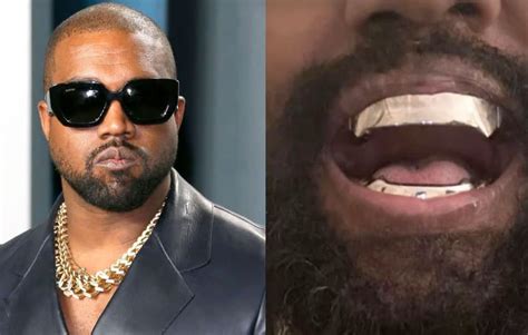Kanye West Replaces Teeth With Aed 3 Million Titanium Dentures