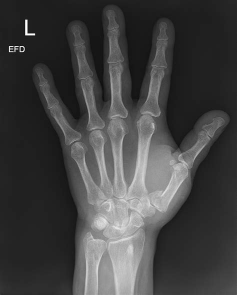 Bennett Fracture Radiology Case