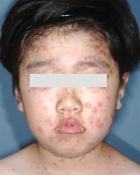 Photograph Showing Multiple Bullae On Face And Lips In A Boy With