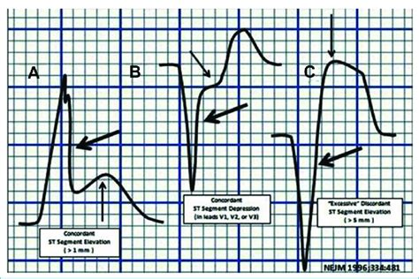 The Presence Of Left Bundle Branch Block And Acute Myocardial