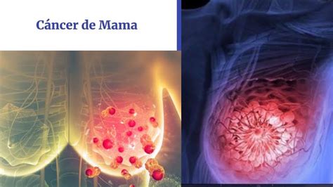 C Ncer De Mama Anatom A B Sica Concepto Clasificaci N Detecci N Temprana Y Diagn Stico Youtube