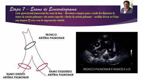 EpisÓdio 7 Estudo Do Tronco Da Artéria Pulmonar E Seus Ramos Youtube