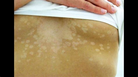 Vitiligo Cure Treatment Tinea Home Remedies For Tinea Versicolor