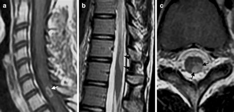 Cervical Spinal Cord Lesions