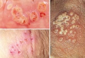 Like if your hsv image is iplimage *src. Stages of Herpes | Med Health Daily