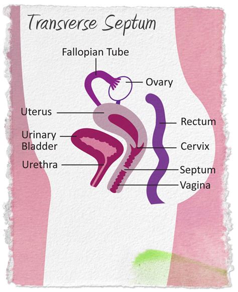 Transverse Vaginal Septum