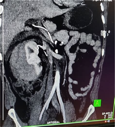 Contrast Ct Coronal Cut Showing Right Sided Large Perinephric Hematoma