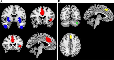 Neurovascular Uncoupling In Schizophrenia A Bimodal Meta Analysis Of Brain Perfusion And