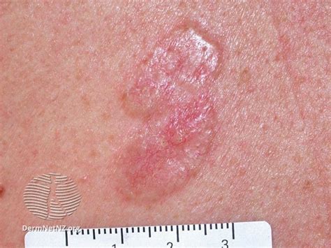Red Scaly Rash Heres Why You Need A Dermatologist To Diagnose You