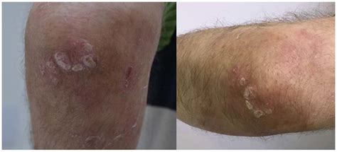 Plaque Type Psoriasis On The Left Elbow Prior To Treatment With Excimer