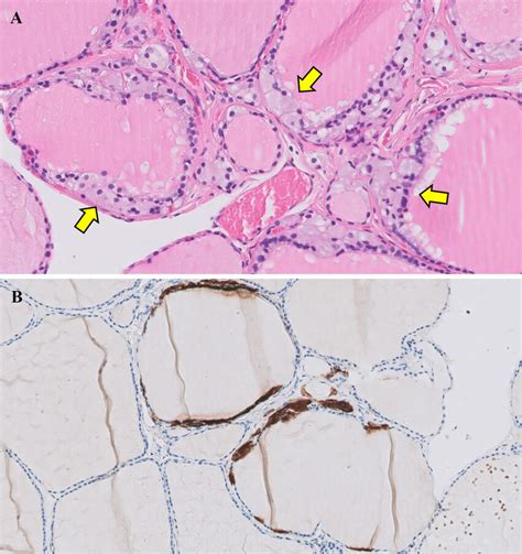 C Cell Hyperplasia In A Patient With Multiple Endocrine Neoplasia Type