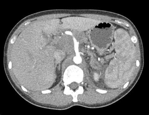 Pancreatic Adenocarcinoma With Extensive Adenopathy Liver Metastases