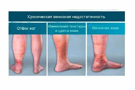 Хроническая недостаточность почек диета Хроническая венозная недостаточность: причины, симптомы, диагностика и Хроническая венозная недостаточность: причины, симптомы, диагностика и Хроническая недостаточность почек диета