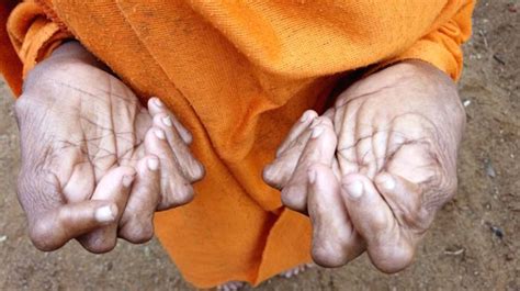 woman born with 19 toes 12 fingers sets new record the samikhsya