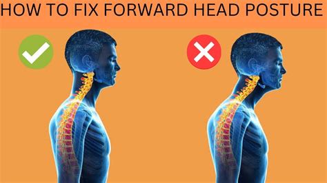 How To Fix Forward Head Posture Fhp With Exercises Youtube