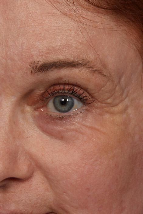 Wrinkle Reduction Gallery Before And After Patient 22 Marina Medspa