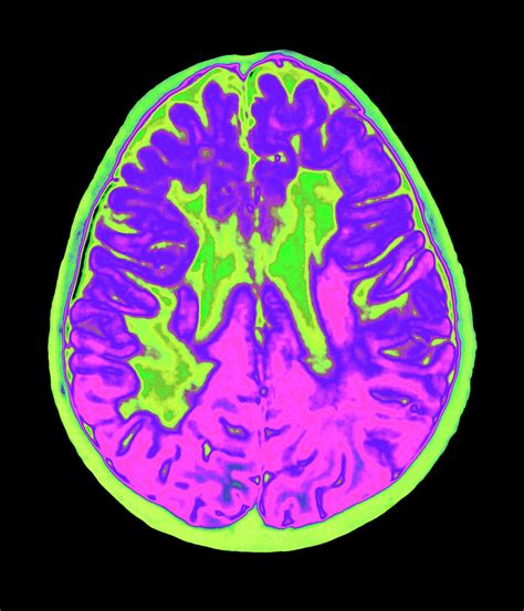Coloured Mri Brain Scan Showing Multiple Sclerosis My Xxx Hot Girl