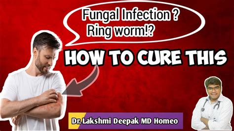 How To Treat Fungal Infection At Home Private Parts Fungal Infection