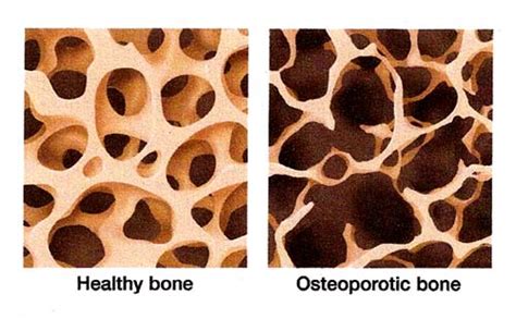 Osteoporosis New Braunfels Brittle Bone Disorders San Marcos
