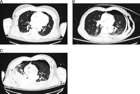 Examples Of Patients With Mild Moderate And Severe Pulmonary